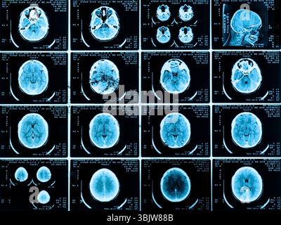 Scans des Gehirns Stockfoto