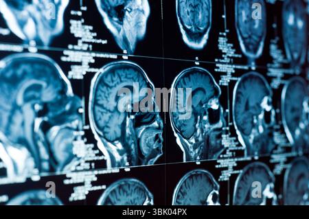 Nahaufnahme eines CT-Scans mit Gehirn und Schädel darauf Stockfoto