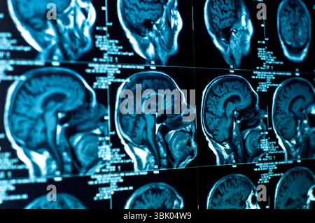 Nahaufnahme eines CT-Scans mit Gehirn Stockfoto