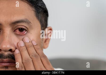 Nahaufnahme des Gesichtes eines asiatischen Mannes mit irritierten roten Augen, möglicherweise verursacht durch Konjunktivitis, Allergie oder Infektion. Er berührt sein Gesicht mit Sorge Stockfoto