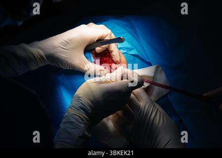 Dermatologische Chirurgie im OP. Schnitt um Läsion, um Haut zu entfernen.Epidermoidkarzinom.die Hände eines Chirurgen und seiner Assistentin eingreifen Stockfoto