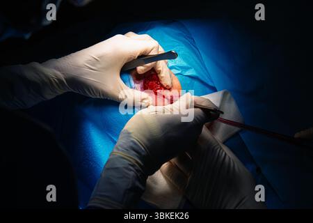 Dermatologische Chirurgie im OP. Schnitt um Läsion, um Haut zu entfernen.Epidermoidkarzinom.die Hände eines Chirurgen und seiner Assistentin eingreifen Stockfoto
