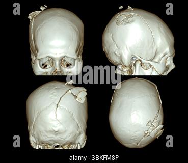 Farbige 3D-Computertomographie (CT)-Scans eines Schädelbruchs. Stockfoto