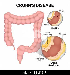 Morbus Crohn Stockfoto