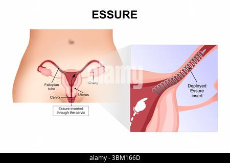 Essure Stockfoto