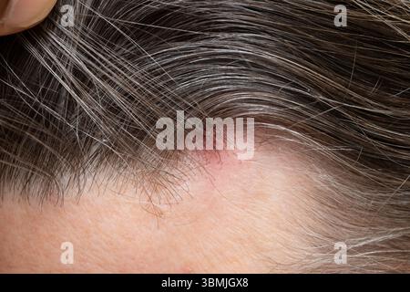 Nahaufnahme des Basalzellkarzinoms auf der Kopfhaut, Hervorhebung des Hautkrebses und dermatologische Untersuchung Stockfoto