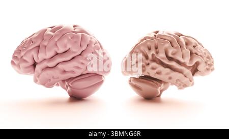 Abbildung: Vergleich eines gesunden Gehirns (links) und eines von Alzheimer betroffenen Gehirns (rechts). Alzheimer-betroffene Gehirne zeigen in Hirnregionen, insbesondere in der Großhirnrinde und im Hippocampus, eine spürbare Schrumpfung und Atrophie. Stockfoto