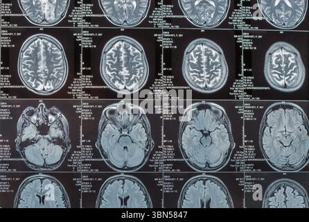Magnetresonanztomographie oder MRT-Bild der Hirnnahmebildung Stockfoto