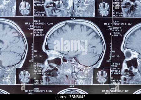 Magnetresonanztomographie oder MRT-Bild der Hirnnahmebildung Stockfoto