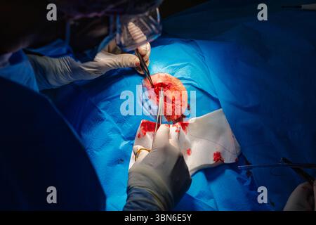 Dermatologische Chirurgie im OP. Die Naht einer chirurgischen Wundverletzung. Plattenepithelkarzinom. Die Hände eines Chirurgen und seiner Assistentin Stockfoto