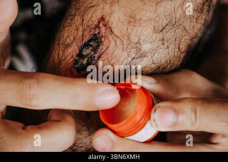 Nahaufnahme einer Person, die Creme auf eine offene Wunde aufträgt, zeigt erste-Hilfe-Behandlung bei Hautverletzungen und Infektionskontrolle. Stockfoto