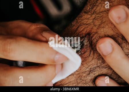 Nahaufnahme einer Person, die einen Hautabszess mit einem Weichteilgewebe reinigt und Eiter und infizierter Bereich zeigt. Dieses Bild stellt die Wundversorgung und Dermatologie dar. Stockfoto