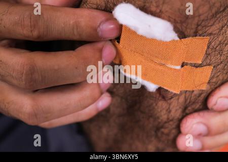 Eine Nahaufnahme einer Person, die einen Verband auf eine Wunde auf ihrer Haut auflegt. Die Person drückt den Verband mit den Fingern an Stockfoto