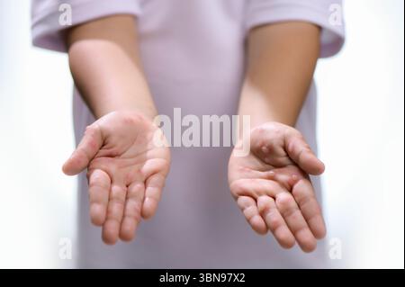 Hand-, Maul- und Klauenseuche HFMD menschliche Hand des Scharlachfiebers beim Coxsackievirus palmarosa Virus und Kinderhand auf weißem Hintergrund Stockfoto