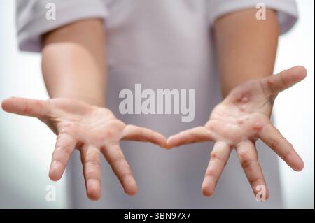 Hand-, Maul- und Klauenseuche HFMD menschliche Hand des Scharlachfiebers beim Coxsackievirus palmarosa Virus und Kinderhand auf weißem Hintergrund Stockfoto