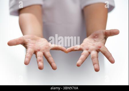 Hand-, Maul- und Klauenseuche HFMD menschliche Hand des Scharlachfiebers beim Coxsackievirus palmarosa Virus und Kinderhand auf weißem Hintergrund Stockfoto