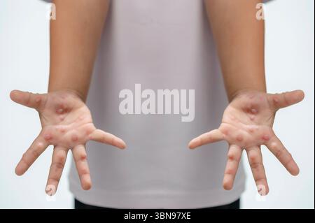 Hand-, Maul- und Klauenseuche HFMD menschliche Hand des Scharlachfiebers beim Coxsackievirus palmarosa Virus und Kinderhand auf weißem Hintergrund Stockfoto