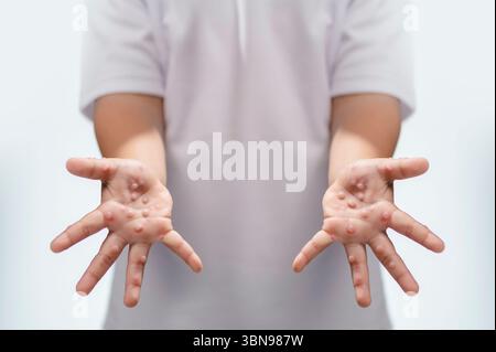 Hand-, Maul- und Klauenseuche HFMD menschliche Hand des Scharlachfiebers beim Coxsackievirus palmarosa Virus und Kinderhand auf weißem Hintergrund Stockfoto