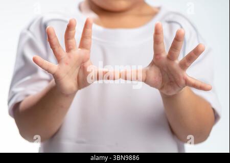 Hand-, Maul- und Klauenseuche HFMD menschliche Hand des Scharlachfiebers beim Coxsackievirus palmarosa Virus und Kinderhand auf weißem Hintergrund Stockfoto