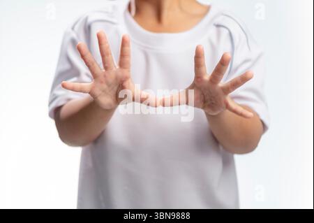 Hand-, Maul- und Klauenseuche HFMD menschliche Hand des Scharlachfiebers beim Coxsackievirus palmarosa Virus und Kinderhand auf weißem Hintergrund Stockfoto