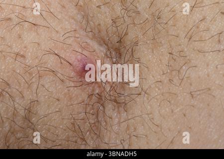 Haut mit Haarfollikeln mit Hämangiom, einem häufigen gutartigen Tumor der Blutgefässe Stockfoto