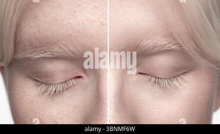 Albino-Frauen-Haut-Makrovergleich: Vor und nach Schönheitshautretusche. Dermatologisches Vorgehen Stockfoto
