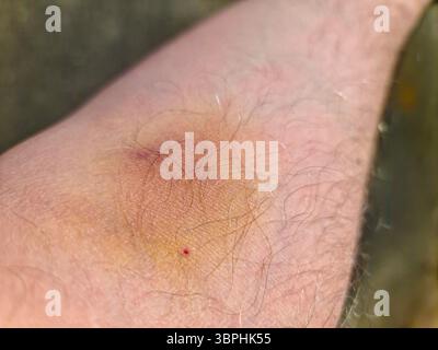 Nahaufnahme eines großen blauen Flusses, der sich nach einer Injektion auf einem behaarten Arm entwickelt, wobei mögliche Nebenwirkungen hervorgehoben werden Stockfoto
