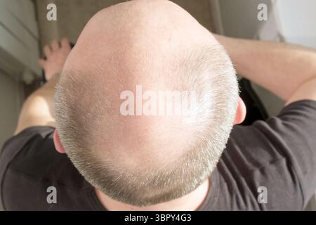 Kahlheit, Mann besorgt wegen Haarausfall. Bekämpfung des Haarausfalls bei Männern. Männlicher Kopf mit Glatze. Nahaufnahme Stockfoto