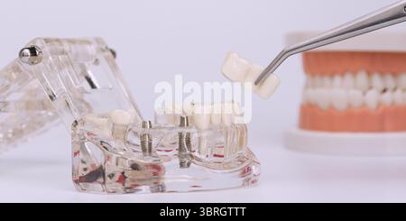Nahaufnahme des Implantatmodells und der Prothesenbrücke mit Pinzette, demonstrieren restaurative zahnärztliche Verfahren und Techniken. Stockfoto