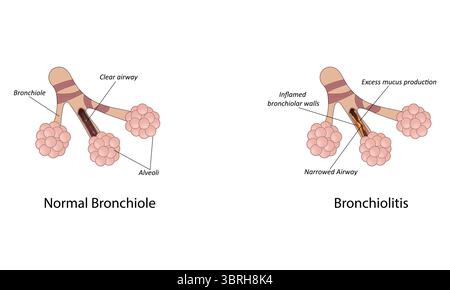 Bronchiolitis-Vektorillustration Stock Vektor