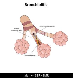 Bronchiolitis-Vektorillustration Stock Vektor
