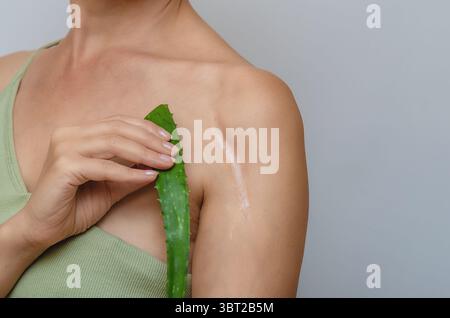 Narbe an der Schulter. Aloe-Blatt weisen auf postoperative Narbe auf der Schulter der Frau hin. Narbenheilung, Behandlung von Narben auf der Haut. Stockfoto
