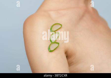 Narbe an der Schulter. Aloe Vera-Schnitte auf postoperativer Narbe auf der Schulter der Frau. Narbenheilung, Behandlung von Narben auf der Haut. Stockfoto