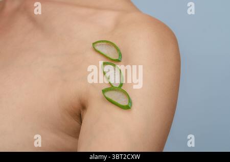 Narbe an der Schulter. Aloe Vera-Schnitte auf postoperativer Narbe auf der Schulter der Frau. Narbenheilung, Behandlung von Narben auf der Haut. Stockfoto