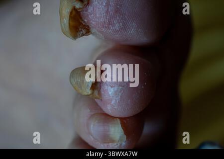 Pilzzzehen-Infektion – Makroaufnahme mit medizinischer Creme-Behandlung. Stockfoto