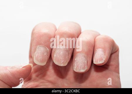 Detaillierte Nahaufnahme einer Hand, die spröde, trockene und abblätternde Nägel zeigt, mit dehydrierter Haut auf einem neutralen grauen Hintergrund. Konzept der Nagelgesundheit. Allerg Stockfoto