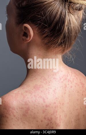 Eine Frau mit einem roten, fleckigen Hautausschlag, verursacht durch Masern. Stockfoto
