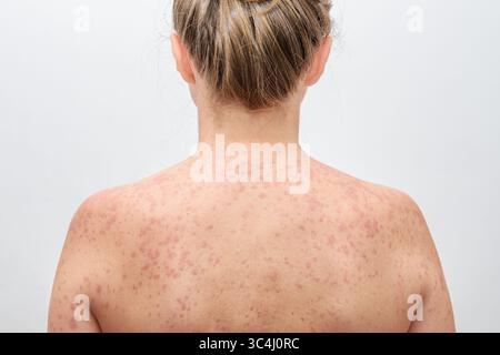 Eine Frau mit einem roten, fleckigen Hautausschlag, verursacht durch Masern. Stockfoto