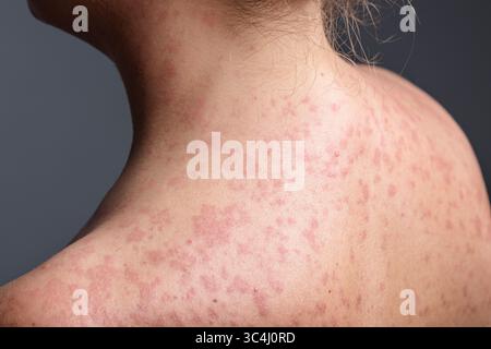 Eine Frau mit einem roten, fleckigen Hautausschlag, verursacht durch Masern. Stockfoto