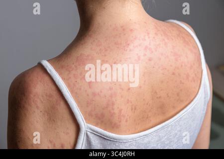 Eine Frau mit einem roten, fleckigen Hautausschlag, verursacht durch Masern. Stockfoto