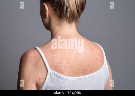 Eine Frau mit einem roten, fleckigen Hautausschlag, verursacht durch Masern. Stockfoto