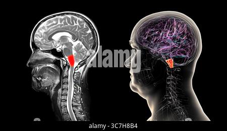 Abbildung einer farbigen Magnetresonanztomographie (MRT) der im menschlichen Gehirn hervorgehobenen Medulla oblongata. Dadurch werden Atmung, Herzschlag und andere wichtige autonome Funktionen gesteuert. Stockfoto