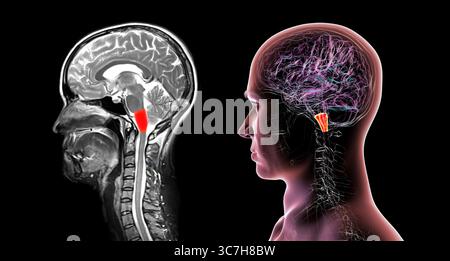 Abbildung einer farbigen Magnetresonanztomographie (MRT) der im menschlichen Gehirn hervorgehobenen Medulla oblongata. Dadurch werden Atmung, Herzschlag und andere wichtige autonome Funktionen gesteuert. Stockfoto