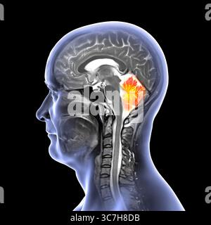 Abbildung einer farbigen Magnetresonanztomographie (MRT) des Gehirns, die das Kleinhirn zeigt. Diese Struktur umfasst Balance, Koordination und Motorsteuerung. Stockfoto