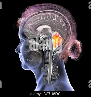 Abbildung einer farbigen Magnetresonanztomographie (MRT) des Gehirns, die das Kleinhirn zeigt. Diese Struktur umfasst Balance, Koordination und Motorsteuerung. Stockfoto