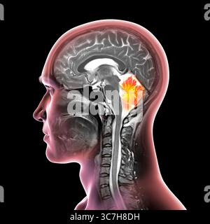 Abbildung einer farbigen Magnetresonanztomographie (MRT) des Gehirns, die das Kleinhirn zeigt. Diese Struktur umfasst Balance, Koordination und Motorsteuerung. Stockfoto