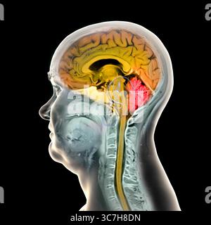Abbildung einer farbigen Magnetresonanztomographie (MRT) des Gehirns und Halses, die die Anatomie des Zentralnervensystems und die Halswirbelsäule zeigt. Gehirn und Rückenmark sind orange und Kleinhirn rot hervorgehoben. Stockfoto