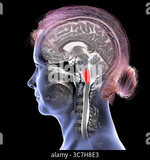 Abbildung einer farbigen Magnetresonanztomographie (MRT) der im menschlichen Gehirn hervorgehobenen Medulla oblongata. Dadurch werden Atmung, Herzschlag und andere wichtige autonome Funktionen gesteuert. Stockfoto