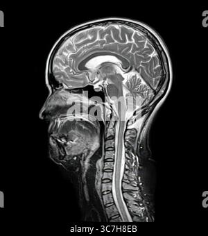 Abbildung einer Magnetresonanztomographie (MRT) des Gehirns und Halses mit Darstellung der Anatomie des Zentralnervensystems und der Halswirbelsäule. Stockfoto
