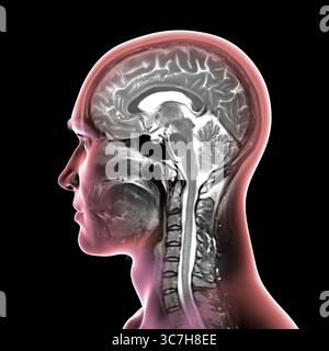 Abbildung einer farbigen Magnetresonanztomographie (MRT) des Gehirns und Halses, die die Anatomie des Zentralnervensystems und die Halswirbelsäule zeigt. Stockfoto